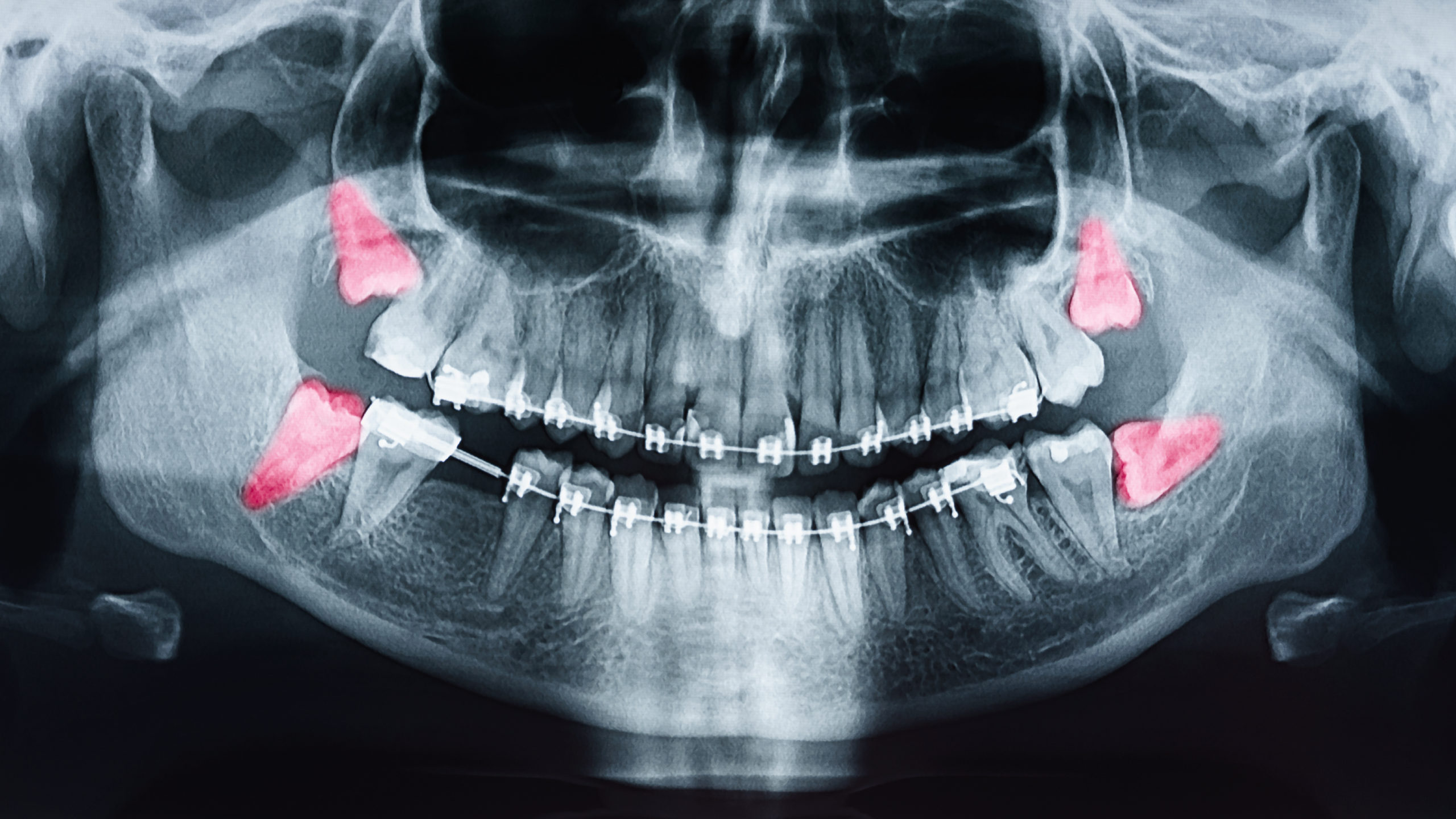 pain-after-wisdom-teeth-surgery-what-s-normal