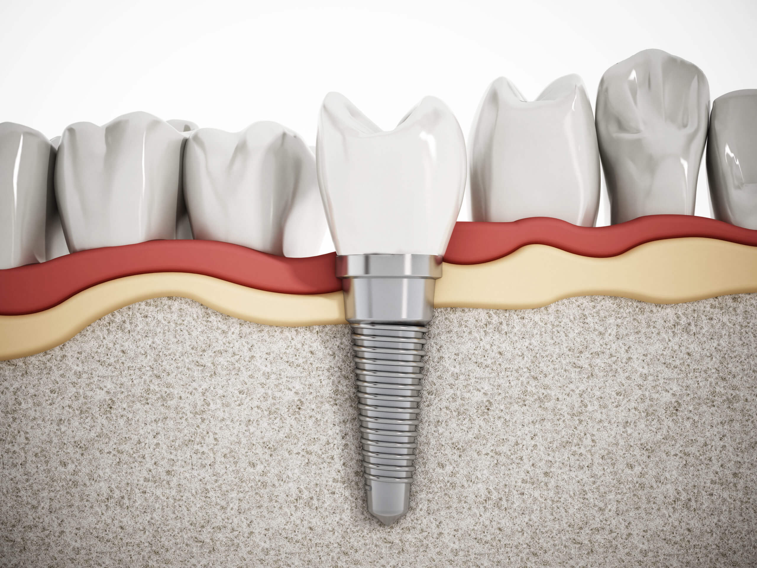 A close up of the tooth implant in its place