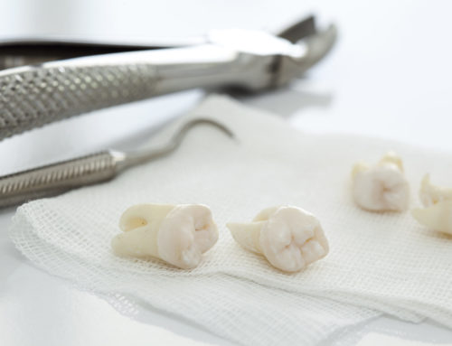 Why Wisdom Tooth Removal Shouldn’t Wait