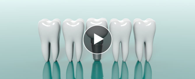A video of teeth with one tooth missing and the other tooth being replaced.
