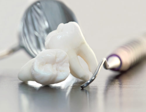5 Tips for a Successful Wisdom Teeth Extraction