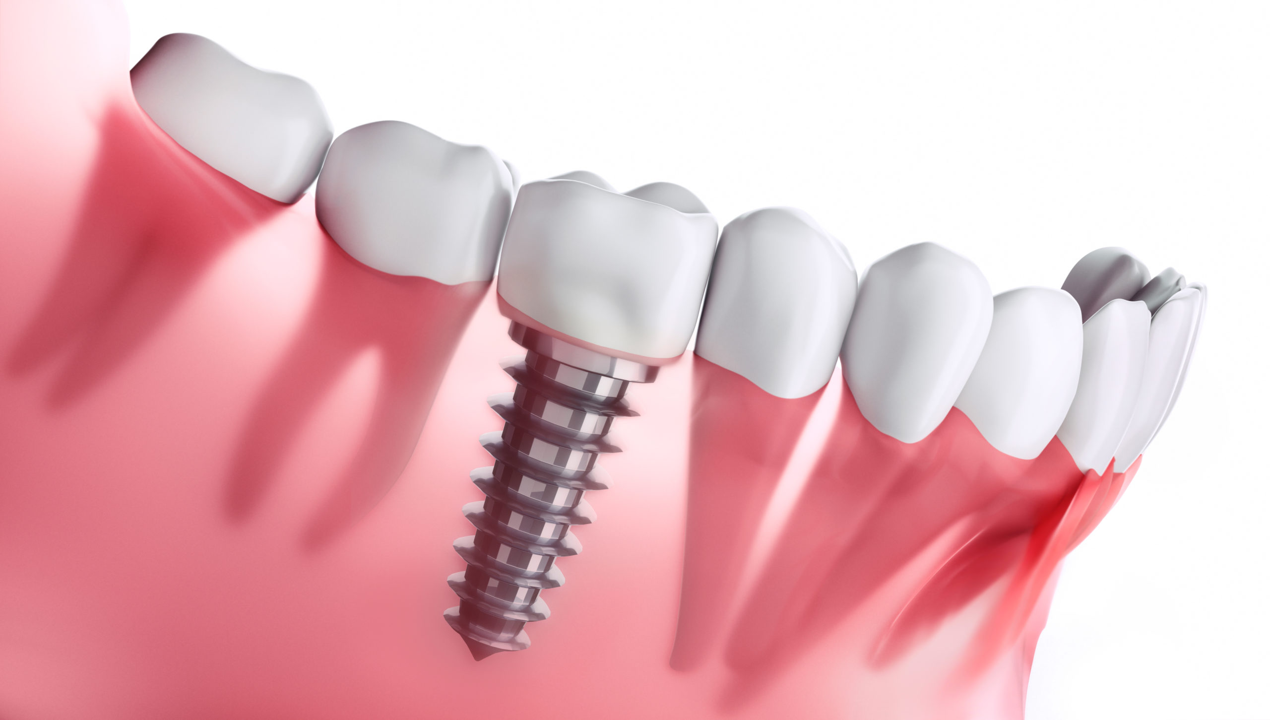 A close up of a tooth with a dental implant