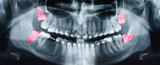 A close up of an x-ray showing teeth and pink gums.