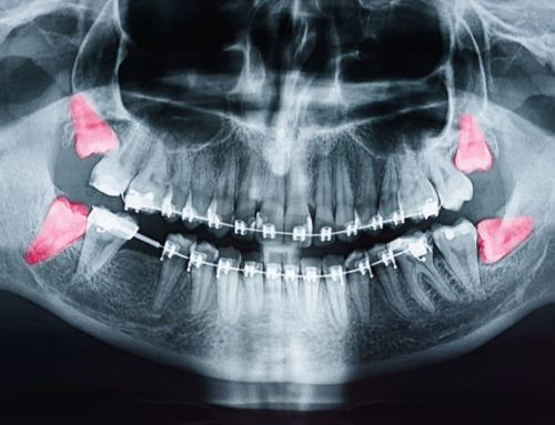 Wisdom Teeth Removal: Why You Should Visit an Oral Surgeon