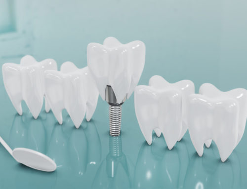 Simple Tips to Support Healing After Dental Implants