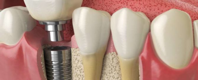A close up of the teeth and implant