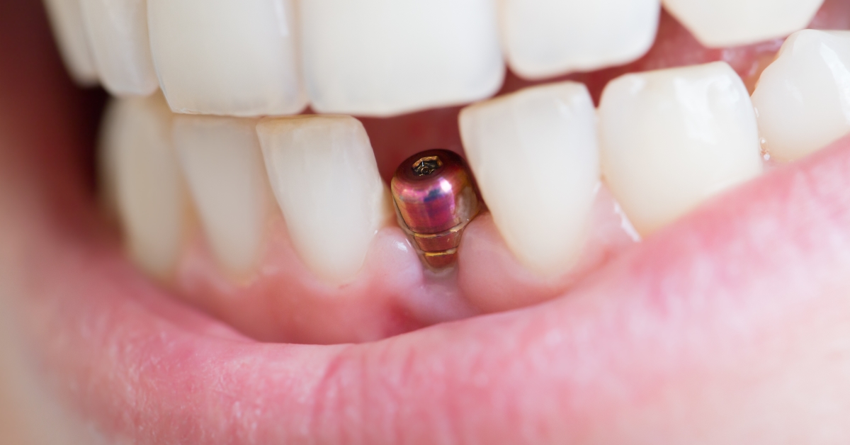 A close up of the tooth with an implant in it