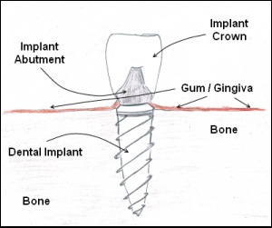 A diagram of an implant with teeth and gums.