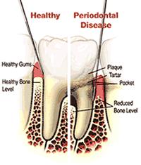 A diagram of the inside of a tooth showing healthy and periodontal disease.