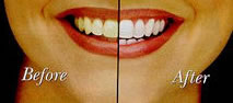 A woman with red lips and teeth before and after whitening.